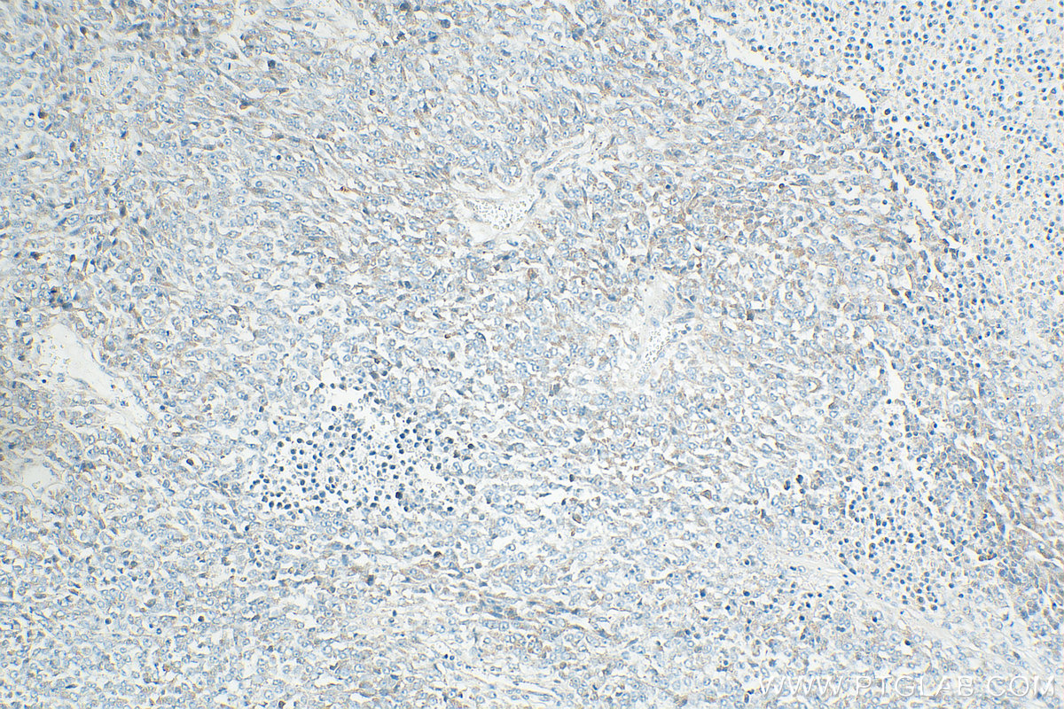 IHC staining of human malignant melanoma using 31291-1-AP IHC staining of human malignant melanoma using 31291-1-AP