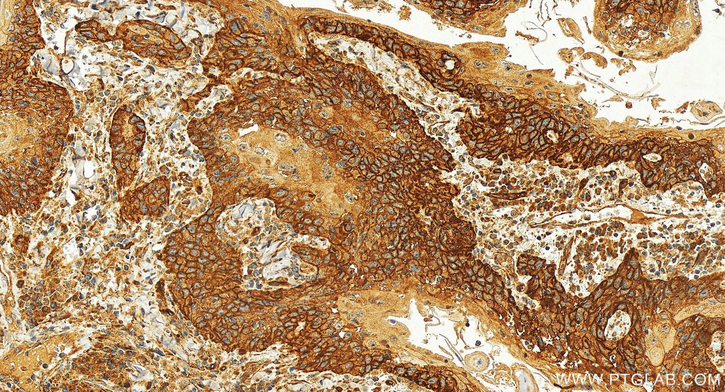 IHC staining of human skin cancer using 31291-1-AP