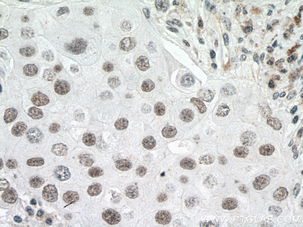 IHC staining of human breast cancer using 15624-1-AP