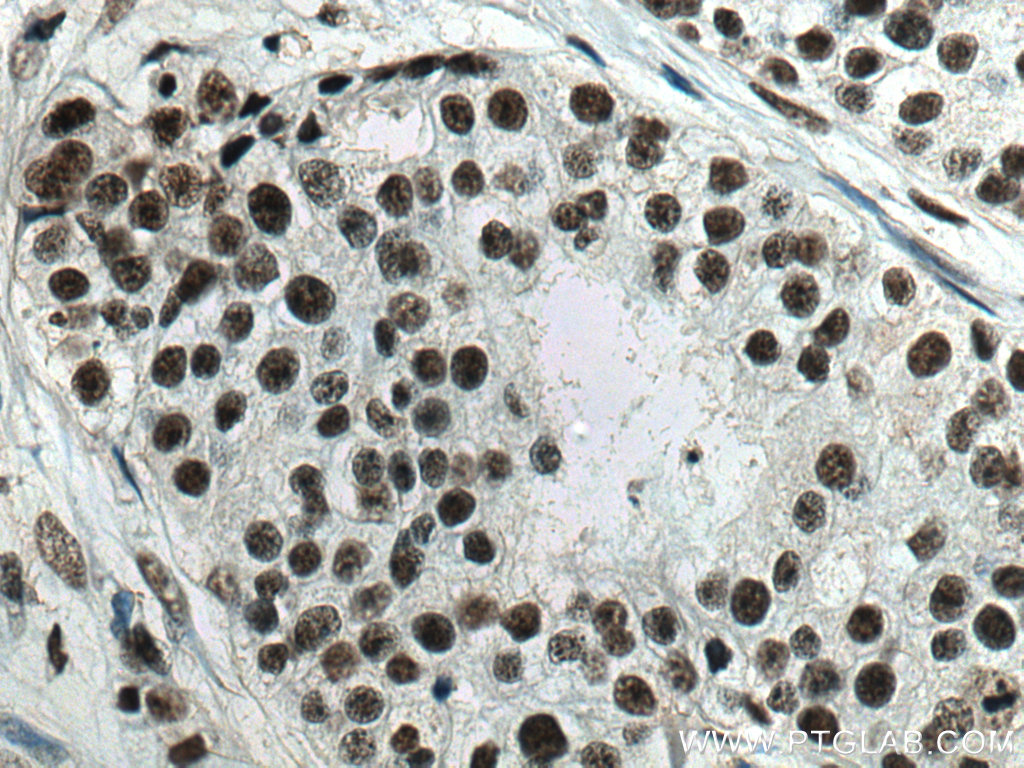 IHC staining of human breast cancer using 60289-1-Ig