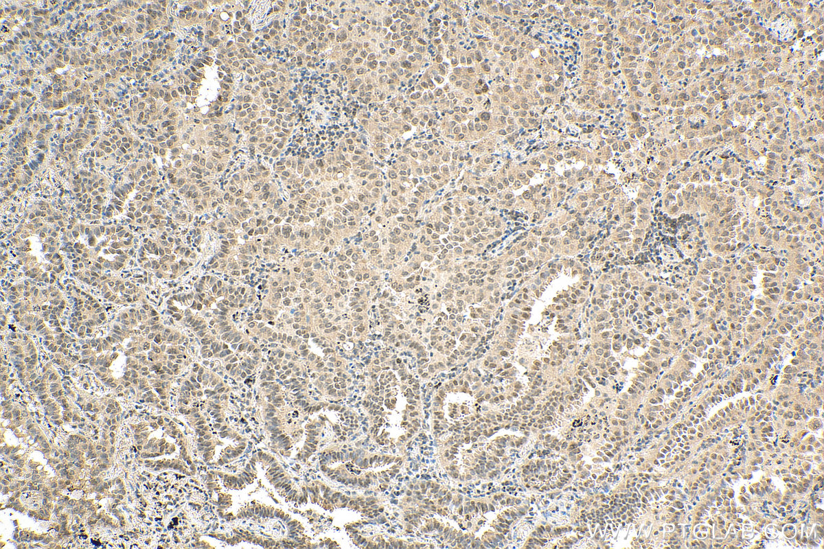 IHC staining of human lung cancer using 10070-1-AP