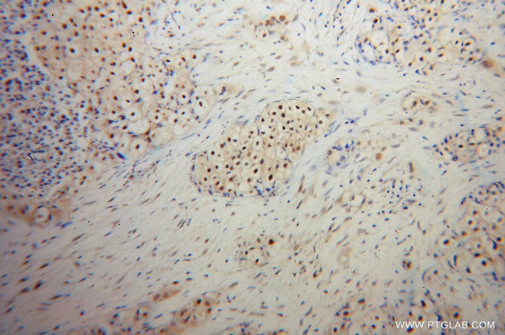 IHC staining of human lung cancer using 10224-1-AP