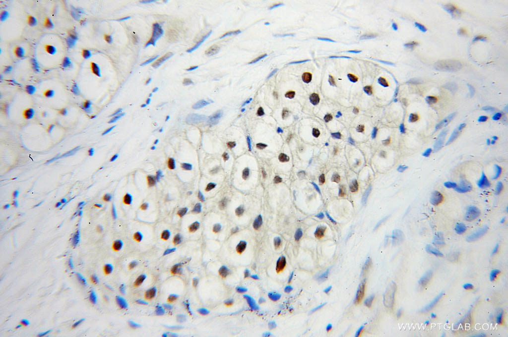 IHC staining of human lung cancer using 10224-1-AP