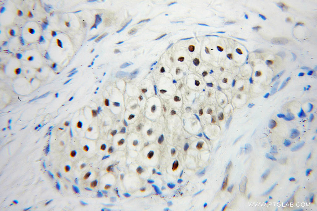 IHC staining of human lung cancer using 10224-1-AP (same clone as 10224-1-PBS)