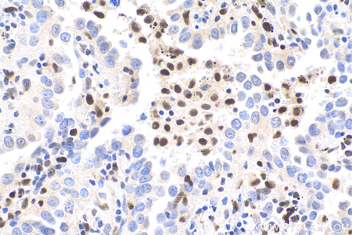 IHC staining of human lung cancer using 13003-2-AP