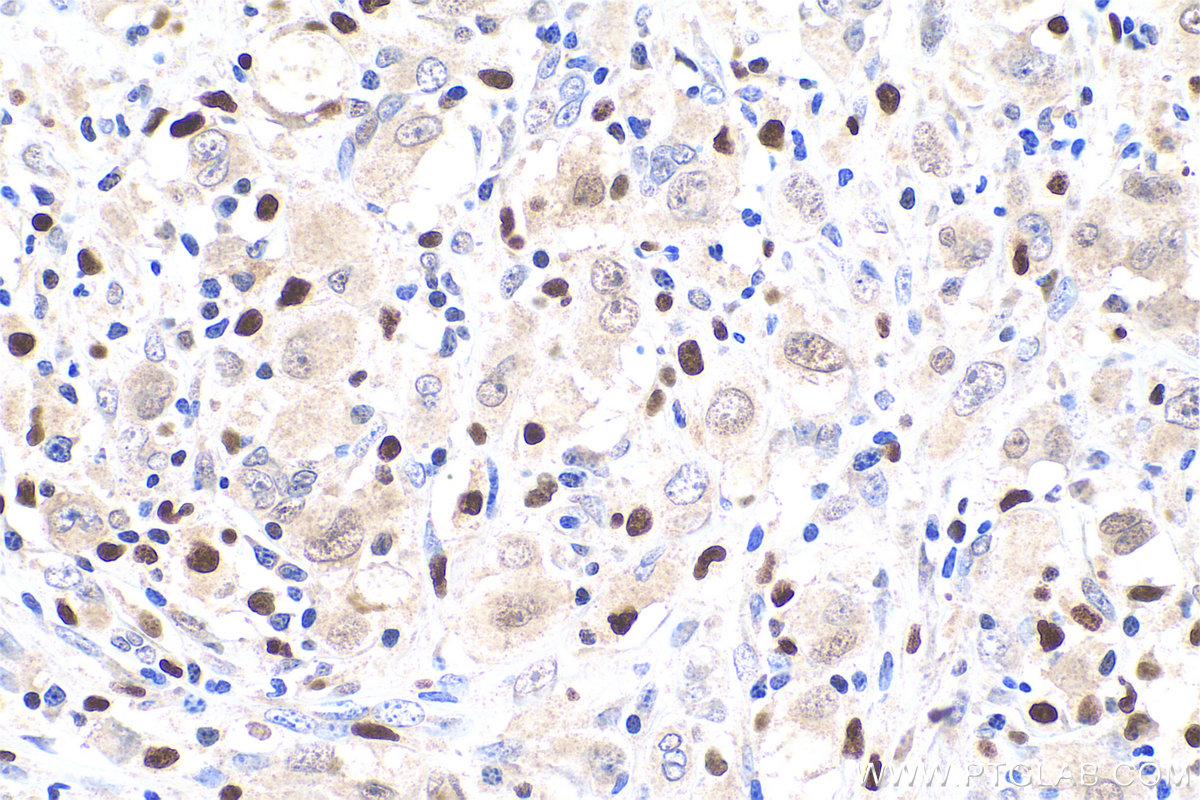 IHC staining of human lymphoma using 13003-2-AP