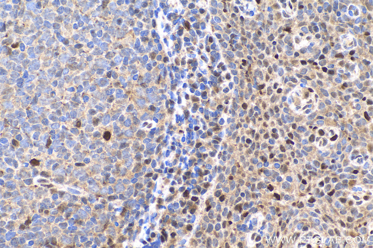 IHC staining of human tonsillitis using 13003-2-AP