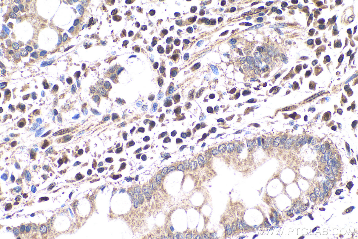 IHC staining of human stomach cancer using 13003-2-AP