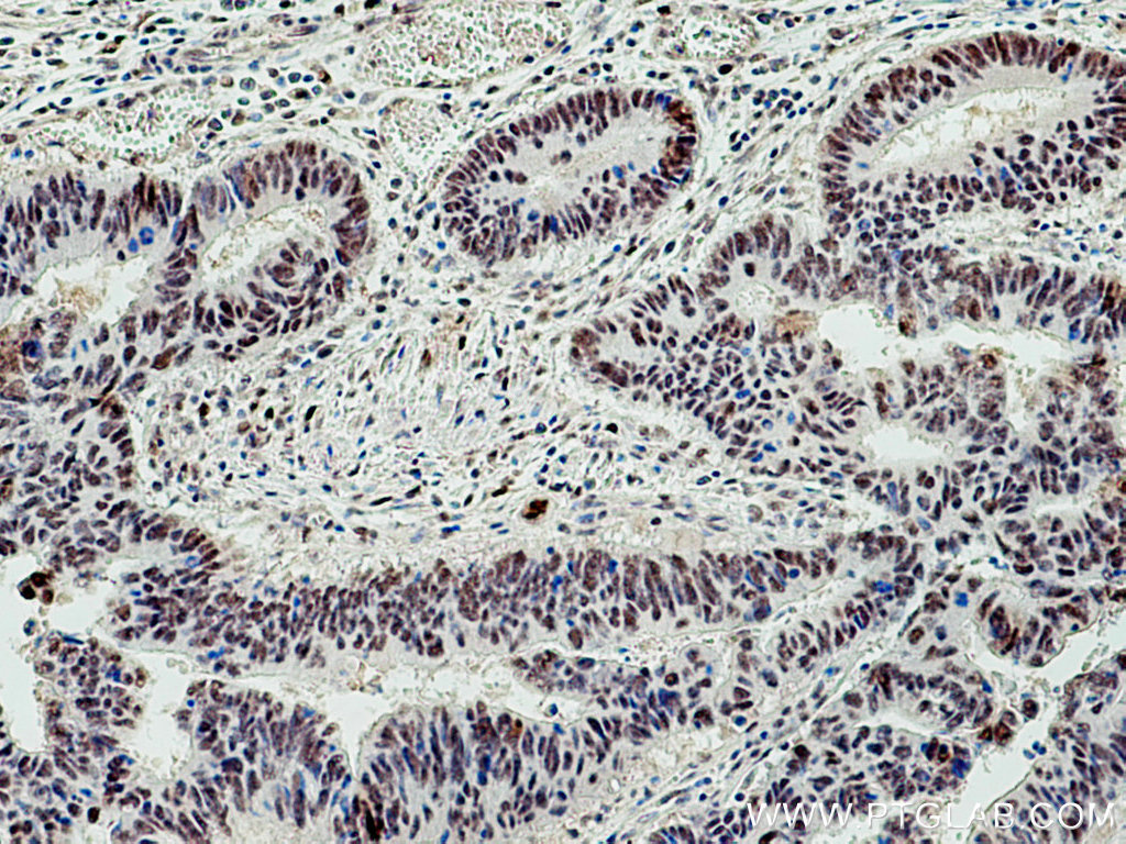 IHC staining of human colon cancer using 67198-1-Ig (same clone as 67198-1-PBS)
