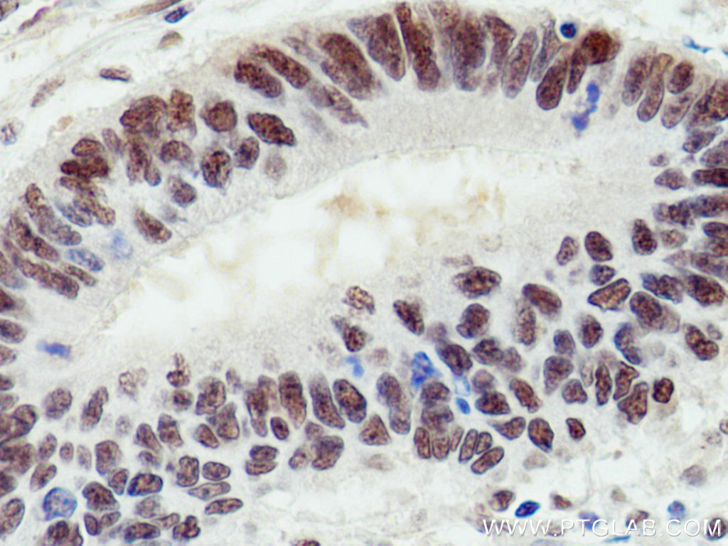 IHC staining of human colon cancer using 67198-1-Ig (same clone as 67198-1-PBS)