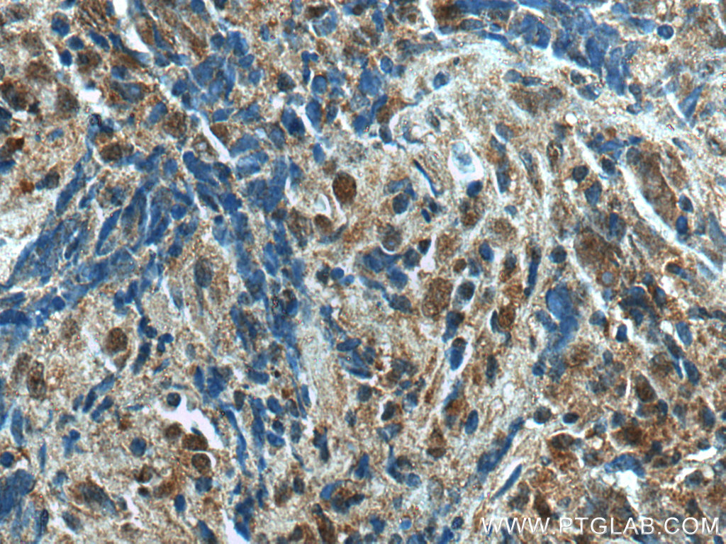 IHC staining of human nasopharyngeal carcinoma using 11080-1-AP