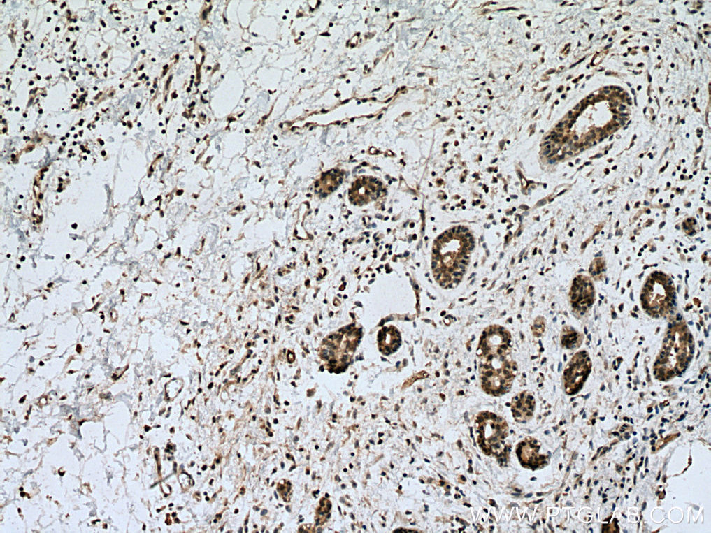 IHC staining of human breast cancer using 28328-1-AP