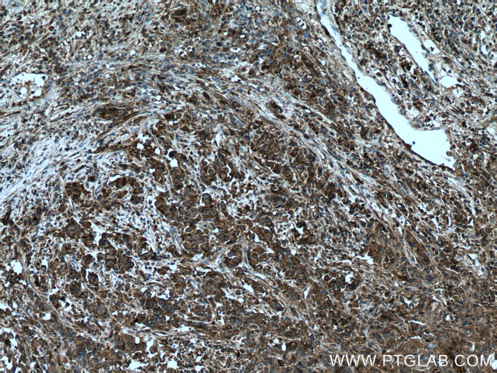 IHC staining of human prostate cancer using 10722-1-AP