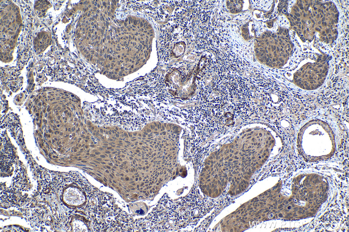 IHC staining of human lung cancer using 14415-1-AP