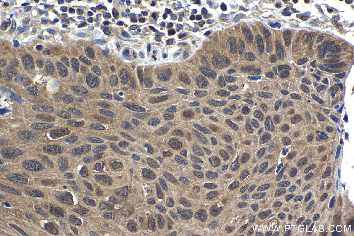IHC staining of human lung cancer using 14415-1-AP (same clone as 14415-1-PBS)