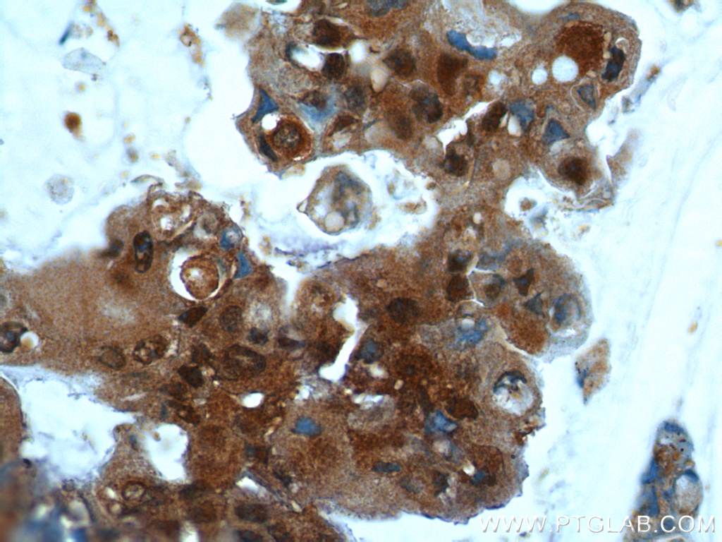 IHC staining of human breast cancer using 10243-1-AP