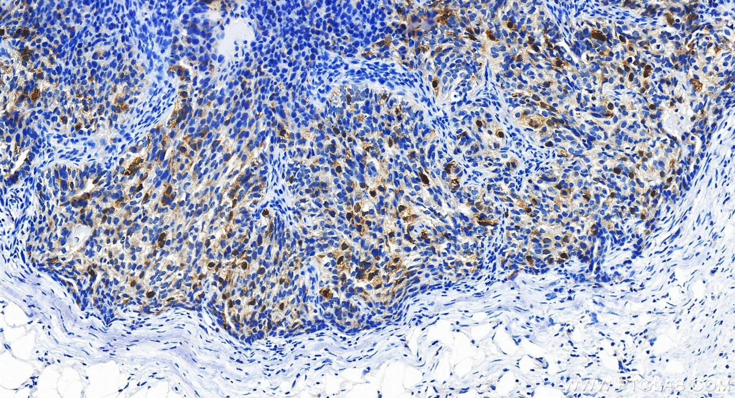 IHC staining of human ovary cancer using 18219-1-AP