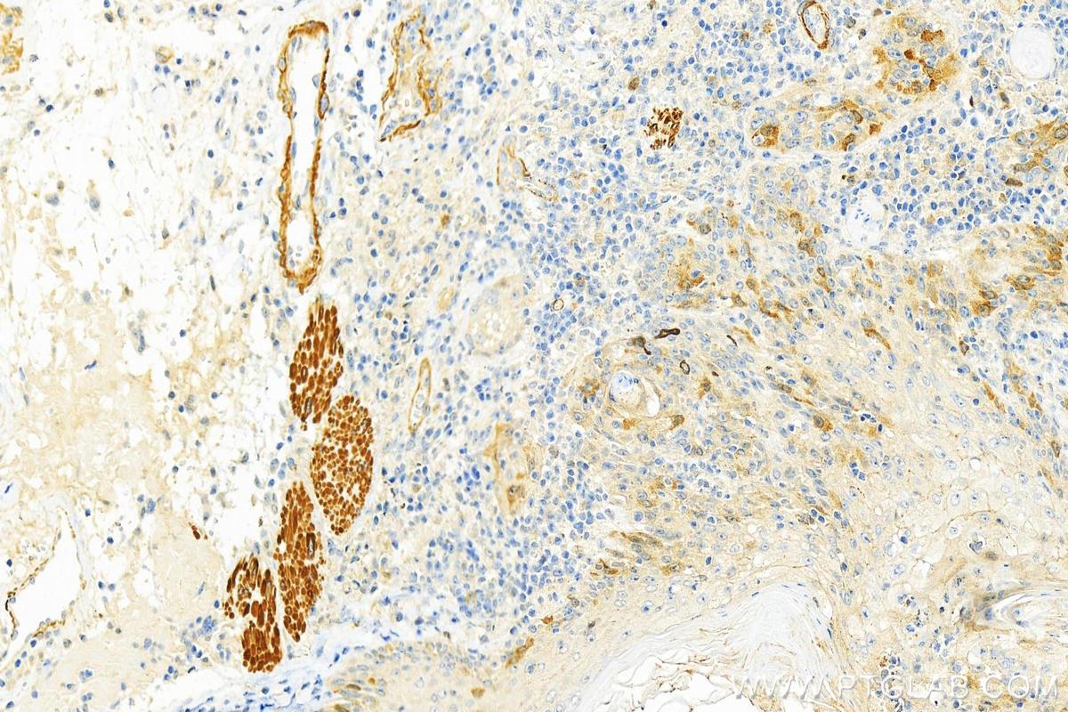 IHC staining of human skin cancer using 18219-1-AP