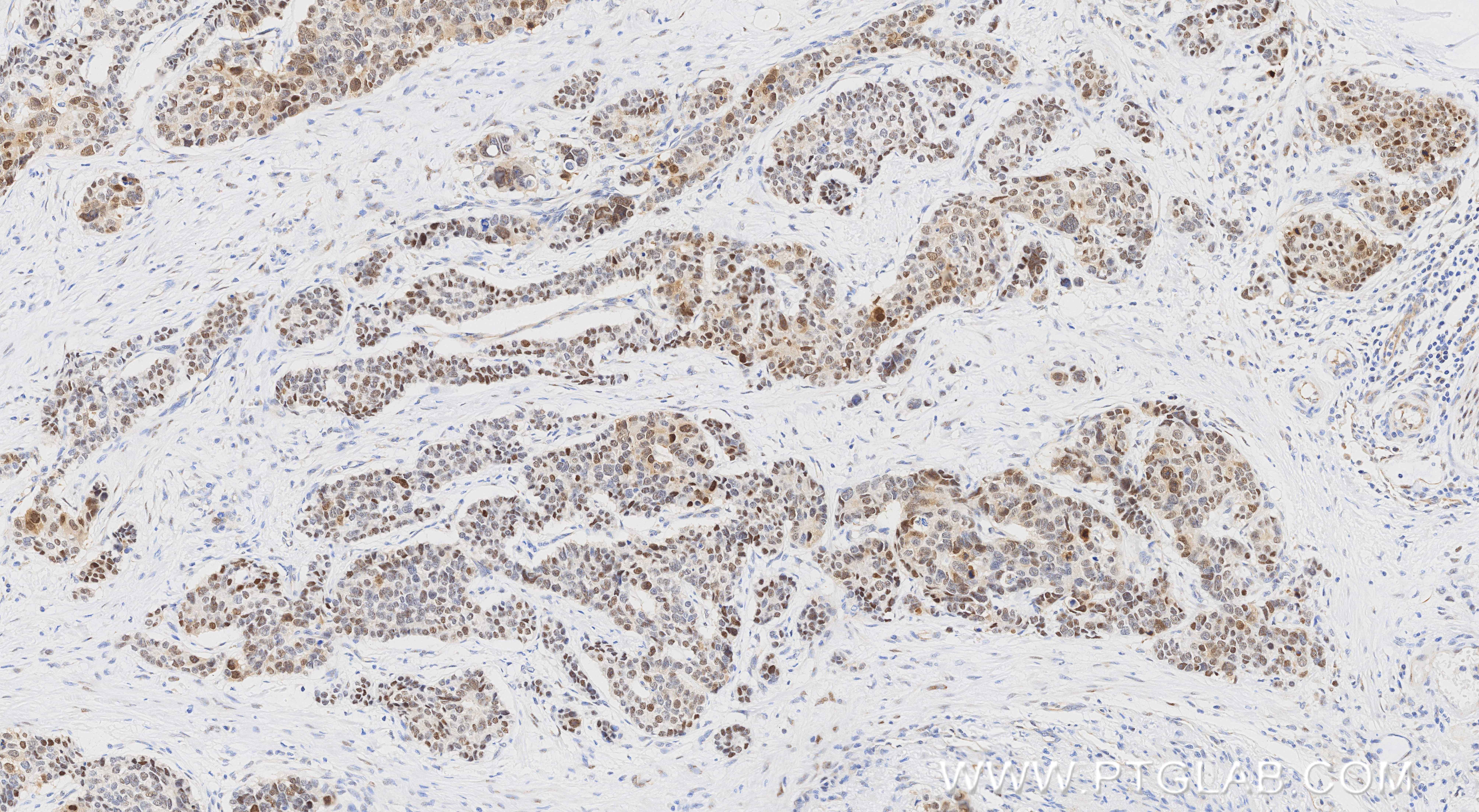 Immunohistochemical analysis of paraffin-embedded human stomach cancer tissue slide using <a class='green' href='/productredirect?CatalogNo=86278-1-RR' target='_blank'>86278-1-RR</a> (UBE2T/HSPC150 antibody) at dilution of 1:1000 (under 10x lens). Heat mediated antigen retrieval with Tris-EDTA buffer (pH 9.0). This data was developed using the same antibody clone with 86278-1-PBS in a different storage buffer formulation. IHC staining of human stomach cancer using 86278-1-RR (same clone as 86278-1-PBS)