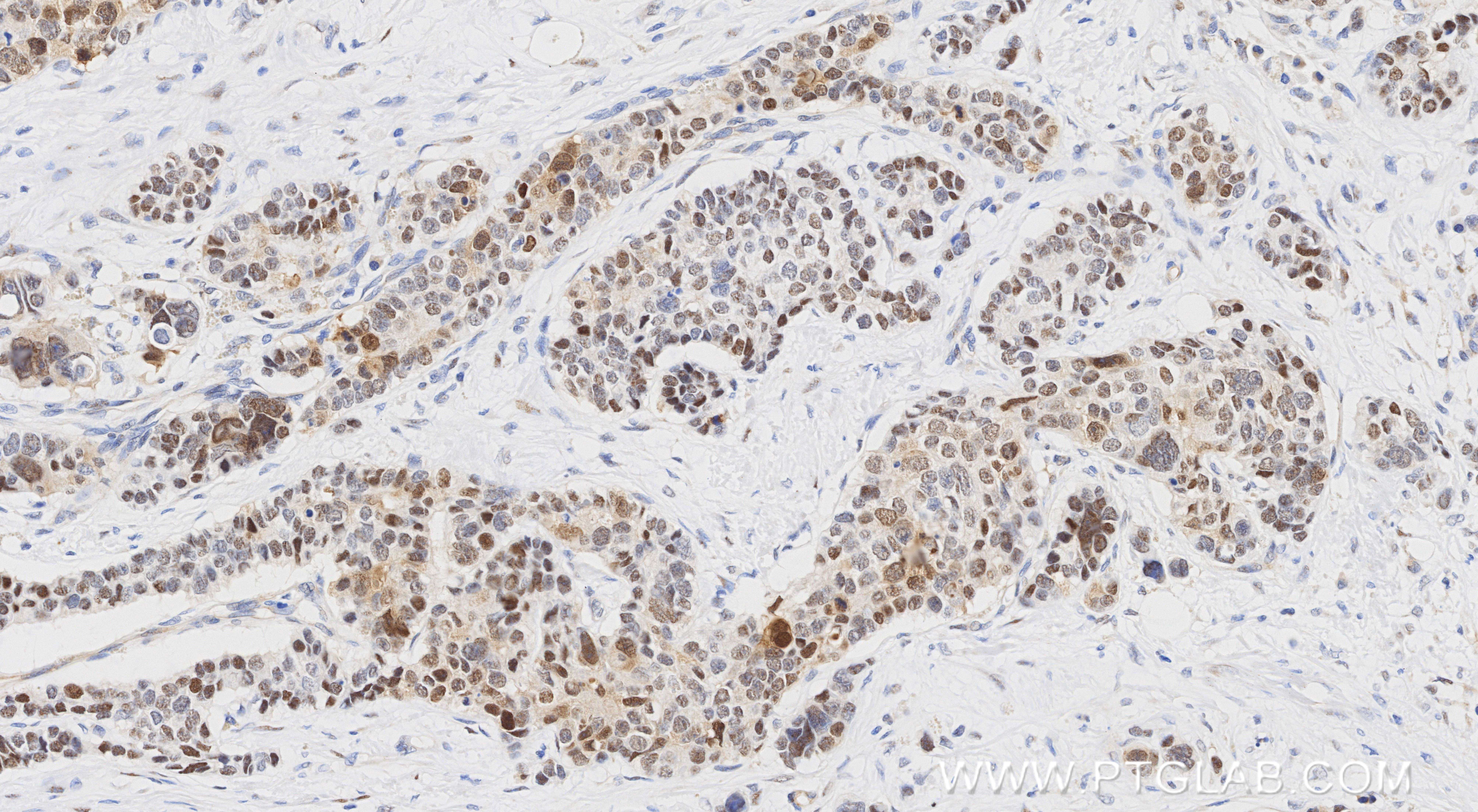 Immunohistochemical analysis of paraffin-embedded human stomach cancer tissue slide using <a class='green' href='/productredirect?CatalogNo=86278-1-RR' target='_blank'>86278-1-RR</a> (UBE2T/HSPC150 antibody) at dilution of 1:1000 (under 20x lens). Heat mediated antigen retrieval with Tris-EDTA buffer (pH 9.0). This data was developed using the same antibody clone with 86278-1-PBS in a different storage buffer formulation. IHC staining of human stomach cancer using 86278-1-RR (same clone as 86278-1-PBS)