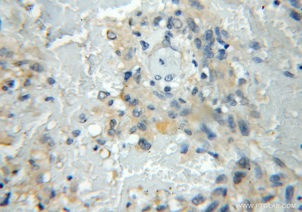 IHC staining of human gliomas using 11564-1-AP