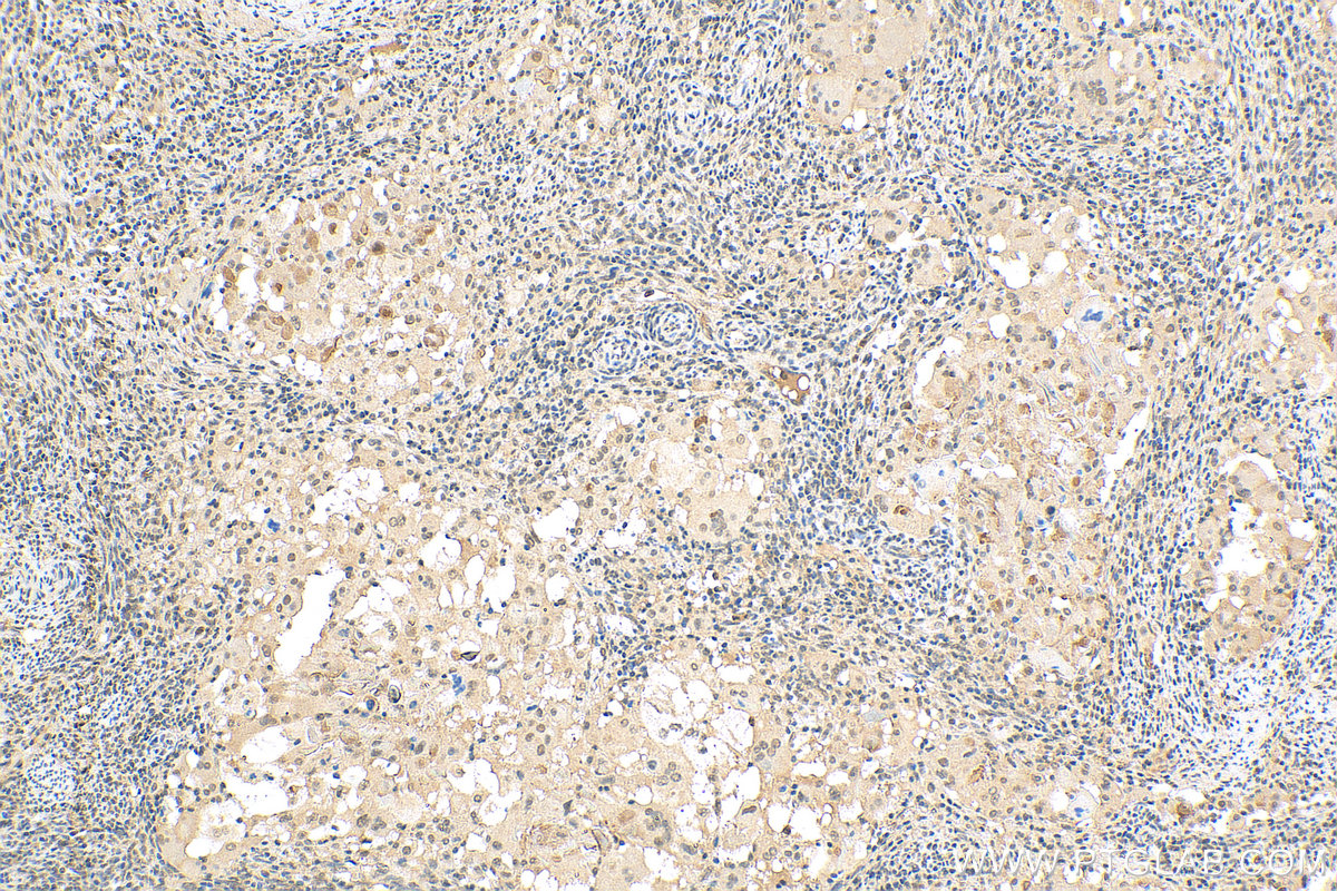 IHC staining of human cervical cancer using 29413-1-AP