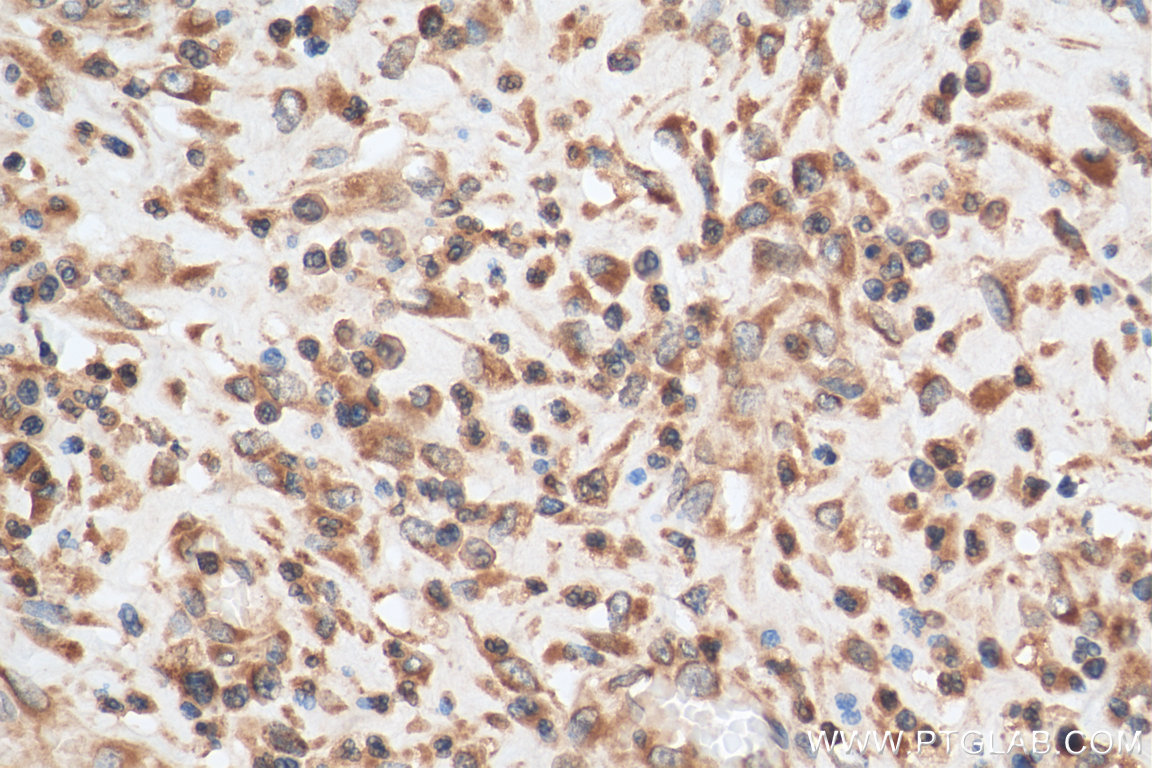 IHC staining of human colon cancer using 21052-1-AP