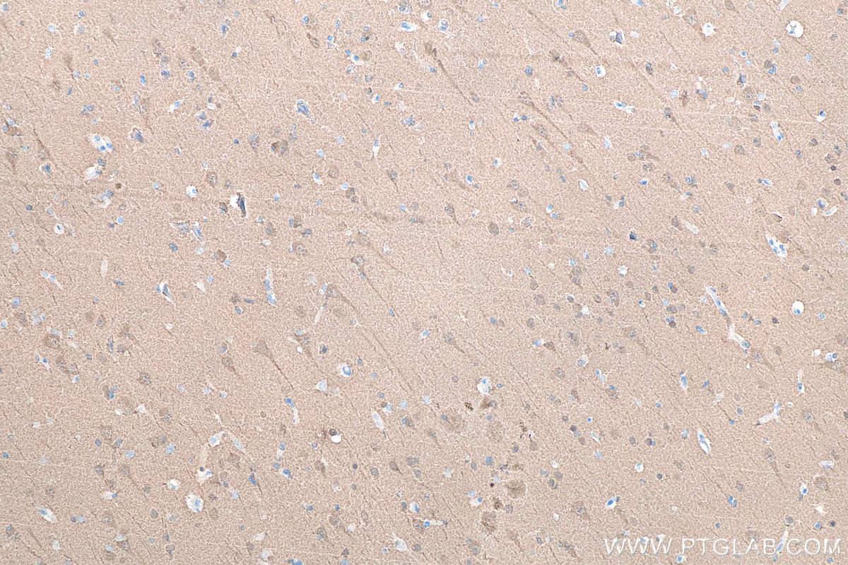IHC staining of human gliomas using 66230-1-Ig IHC staining of human gliomas using 66230-1-Ig