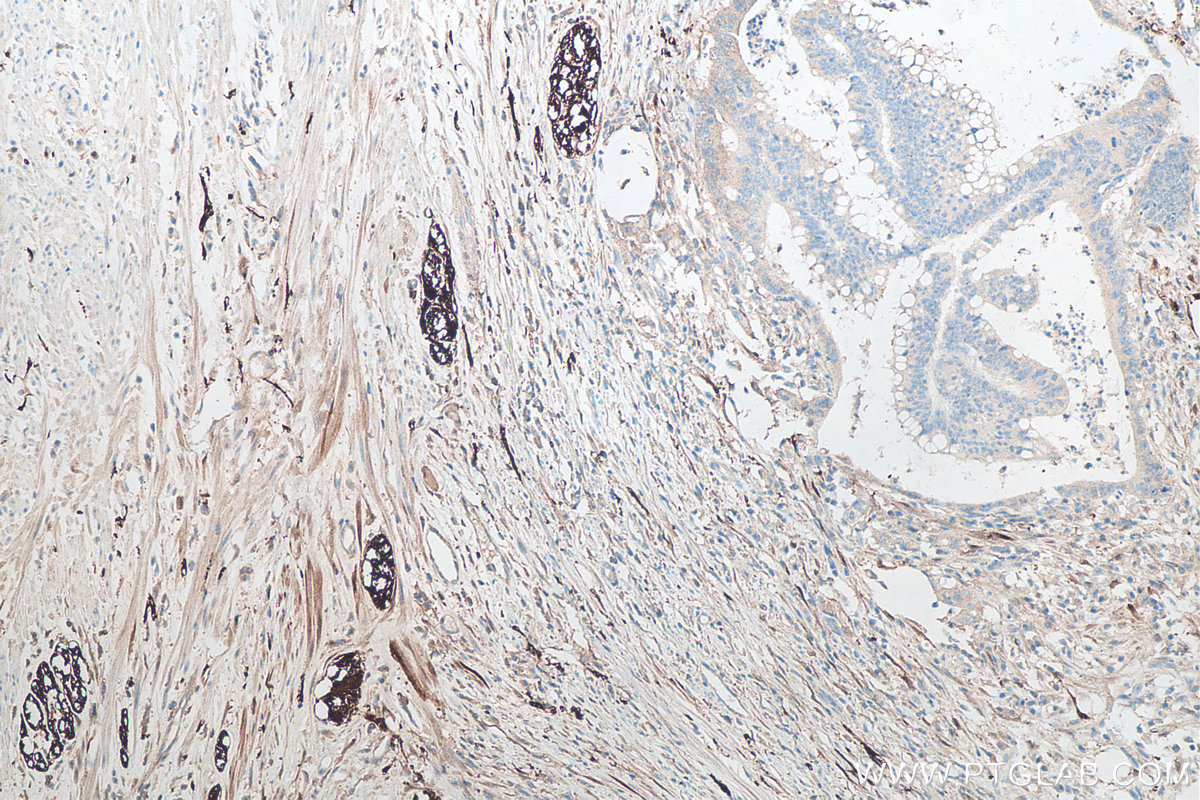 IHC staining of human colon cancer using 66230-1-Ig IHC staining of human colon cancer using 66230-1-Ig