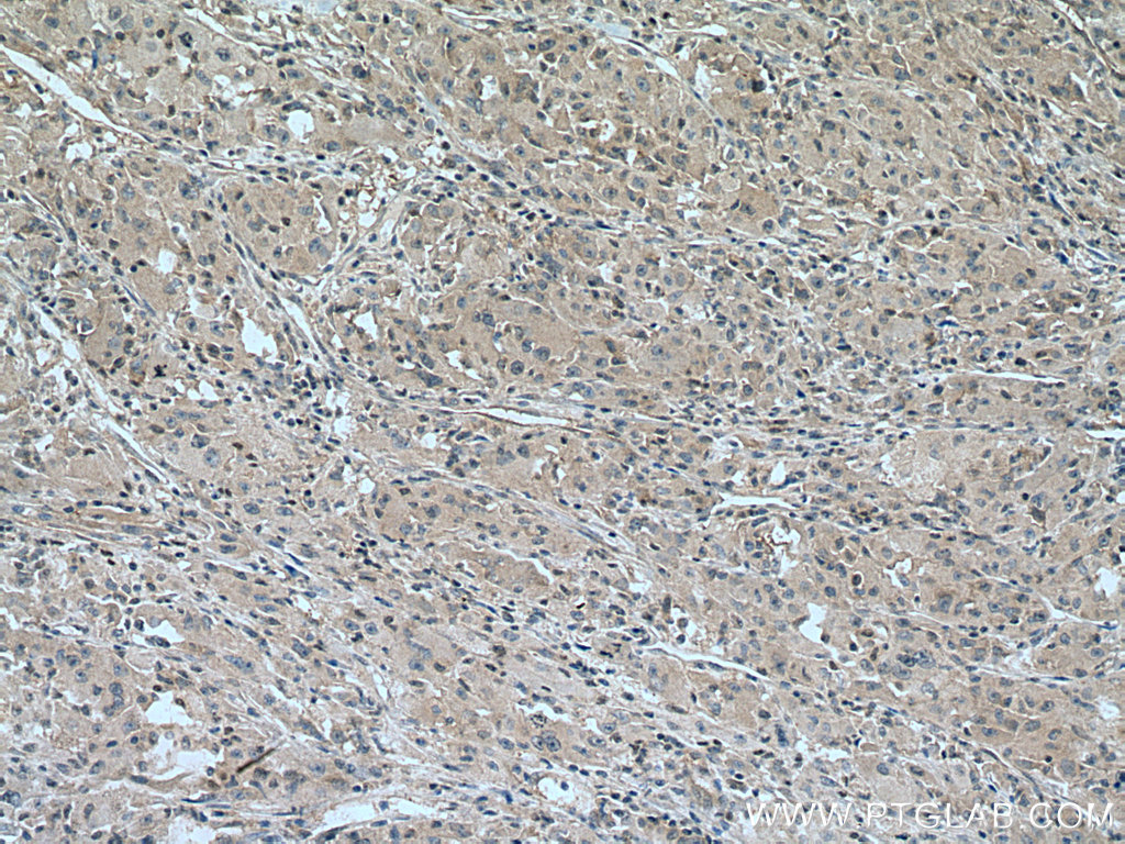 IHC staining of human liver cancer using 28762-1-AP