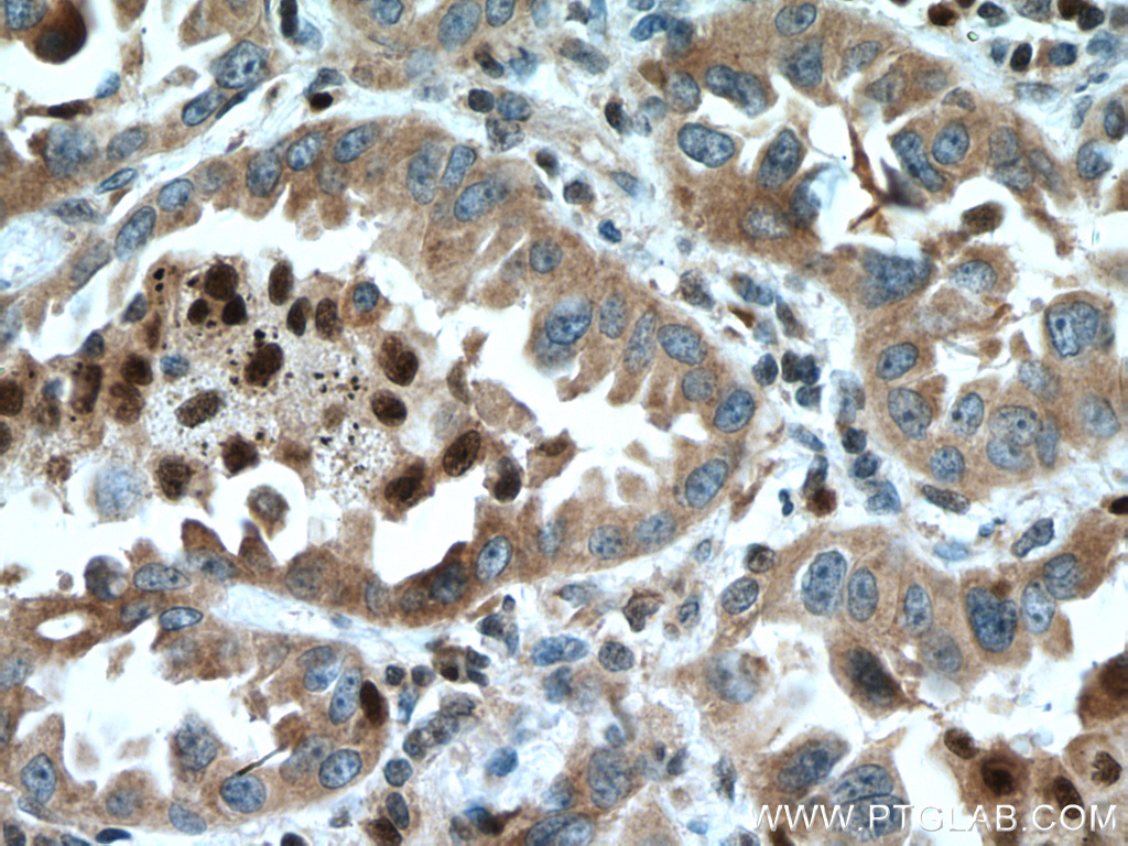 IHC staining of human lung cancer using 15883-1-AP