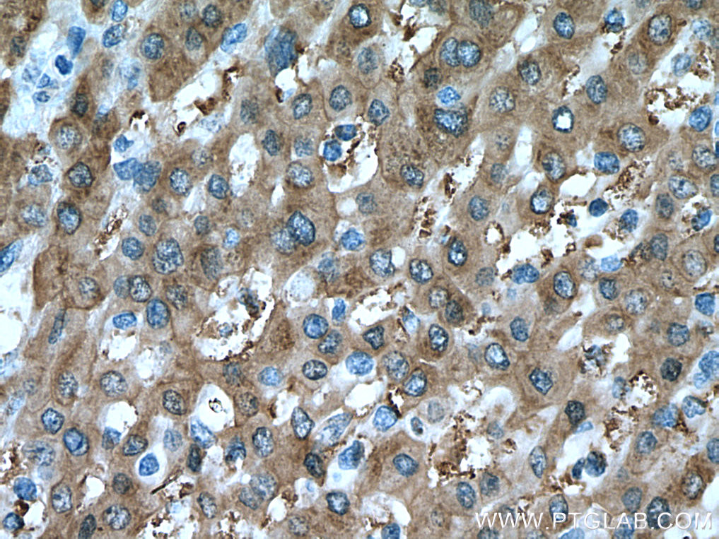 IHC staining of human liver cancer using 67360-1-Ig