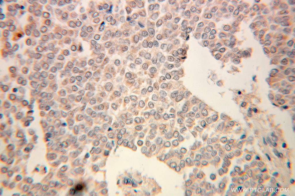 IHC staining of human ovary tumor using 10391-1-AP