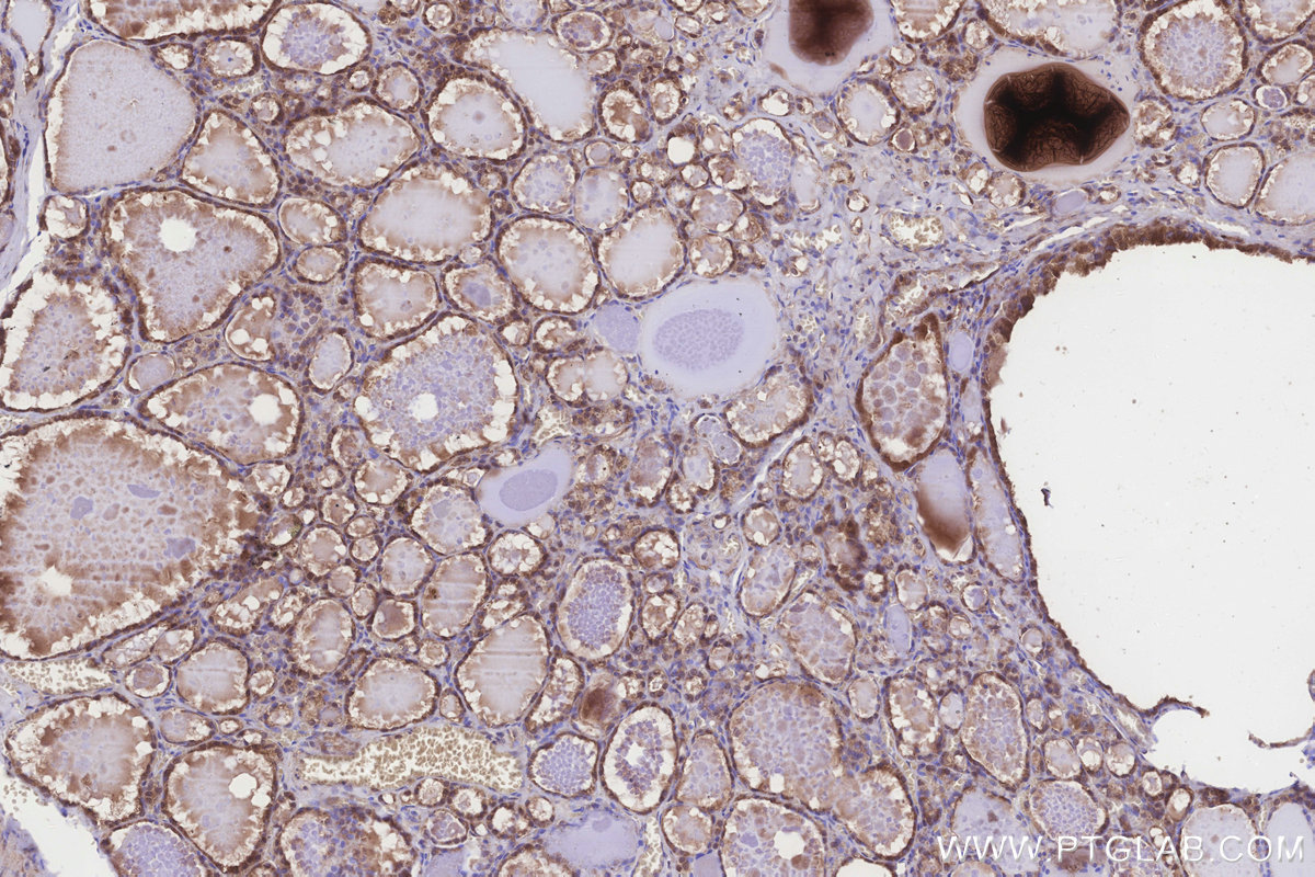 IHC staining of human thyroid cancer using 24345-1-AP IHC staining of human thyroid cancer using 24345-1-AP