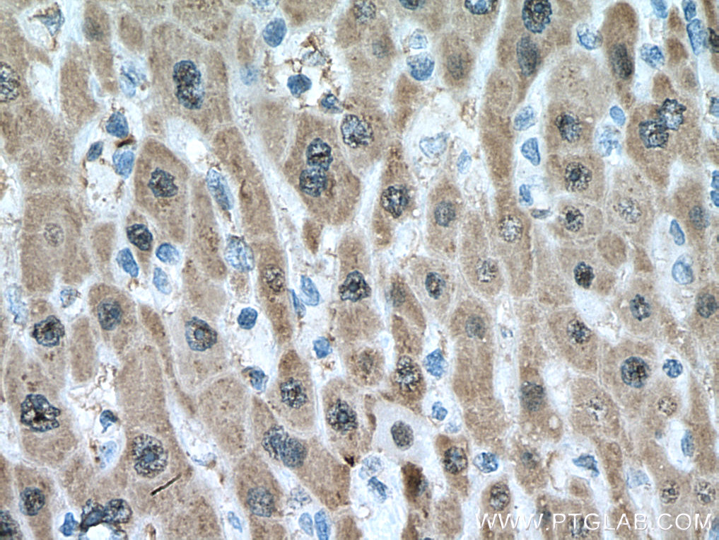 IHC staining of human liver cancer using 67490-1-Ig (same clone as 67490-1-PBS)