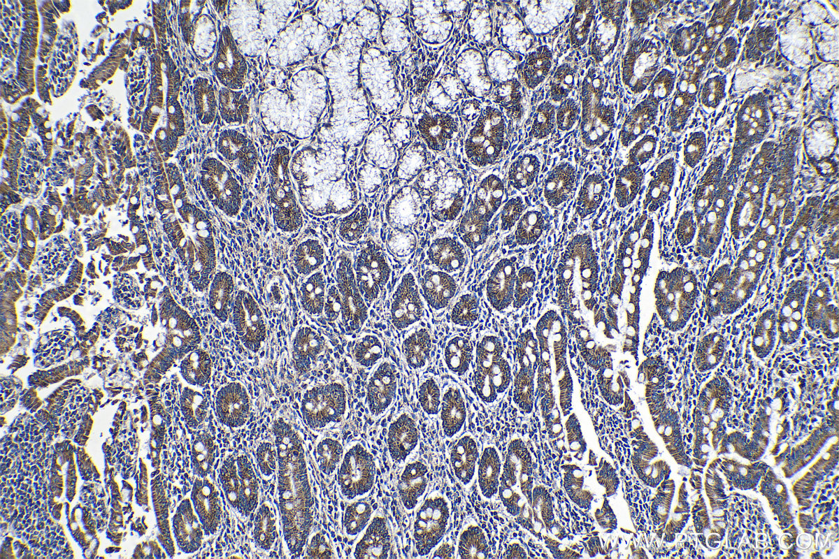 IHC staining of human stomach cancer using 18443-1-AP