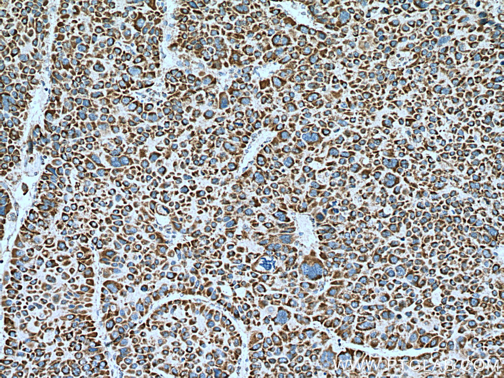 IHC staining of human liver cancer using 14975-1-AP