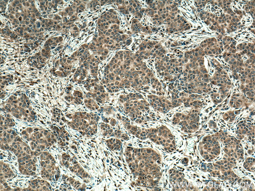 IHC staining of human breast cancer using 67144-1-Ig