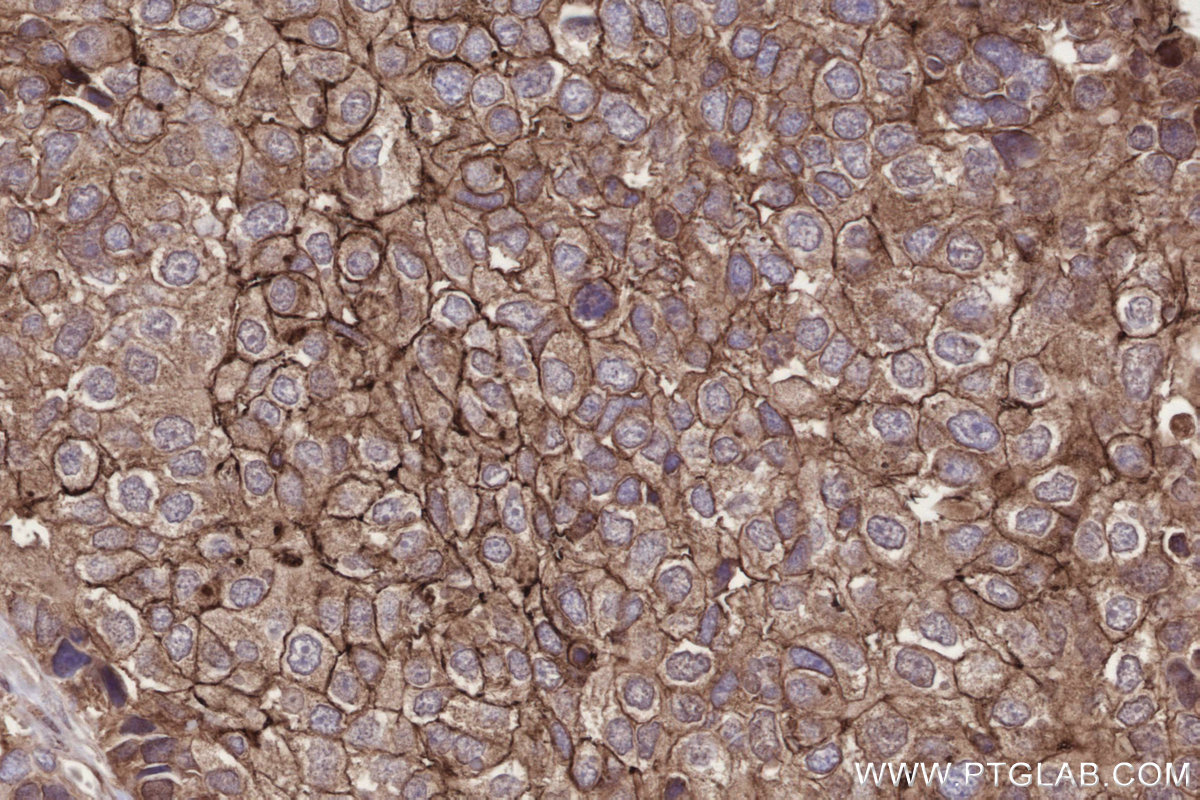 IHC staining of human stomach cancer using 67144-1-Ig IHC staining of human stomach cancer using 67144-1-Ig