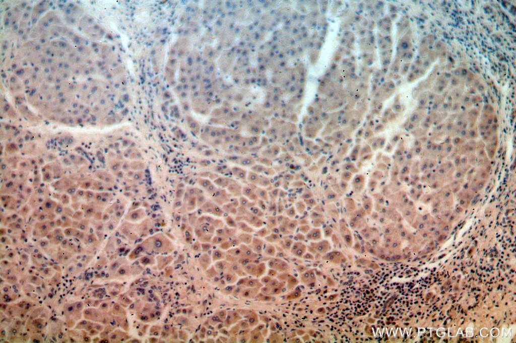 IHC staining of human hepatocirrhosis using 15285-1-AP