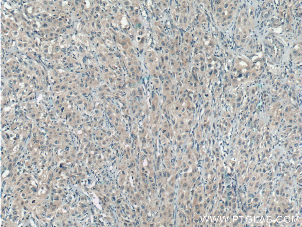 IHC staining of human cervical cancer using 14913-1-AP