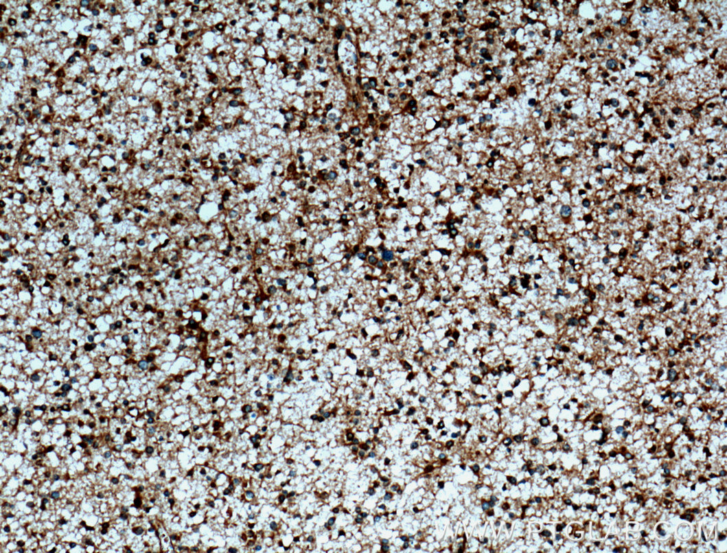 IHC staining of human gliomas using 13509-1-AP