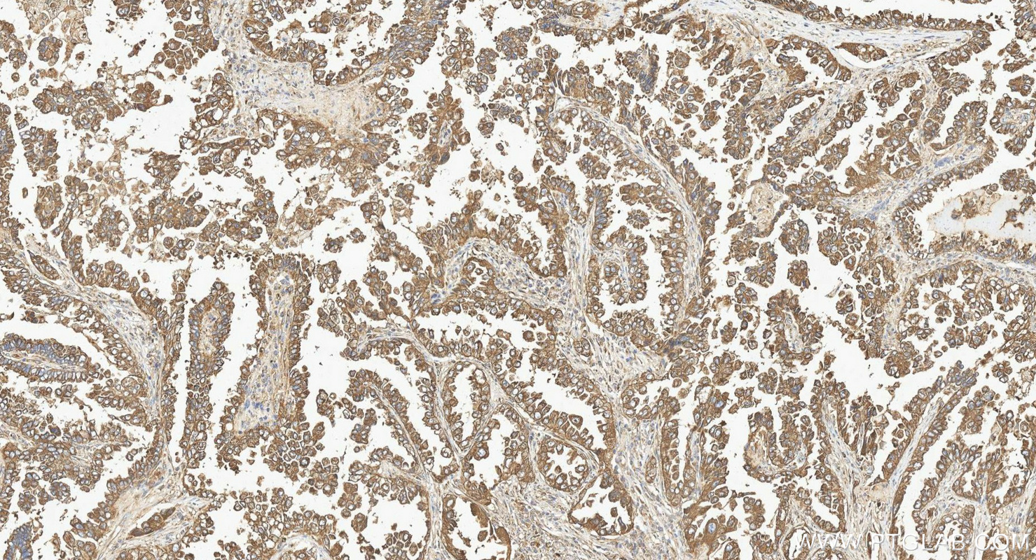 IHC staining of human lung cancer using 13509-1-AP IHC staining of human lung cancer using 13509-1-AP