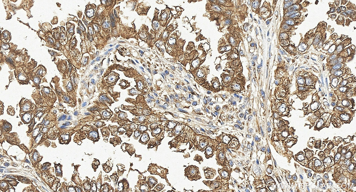 IHC staining of human lung cancer using 13509-1-AP IHC staining of human lung cancer using 13509-1-AP