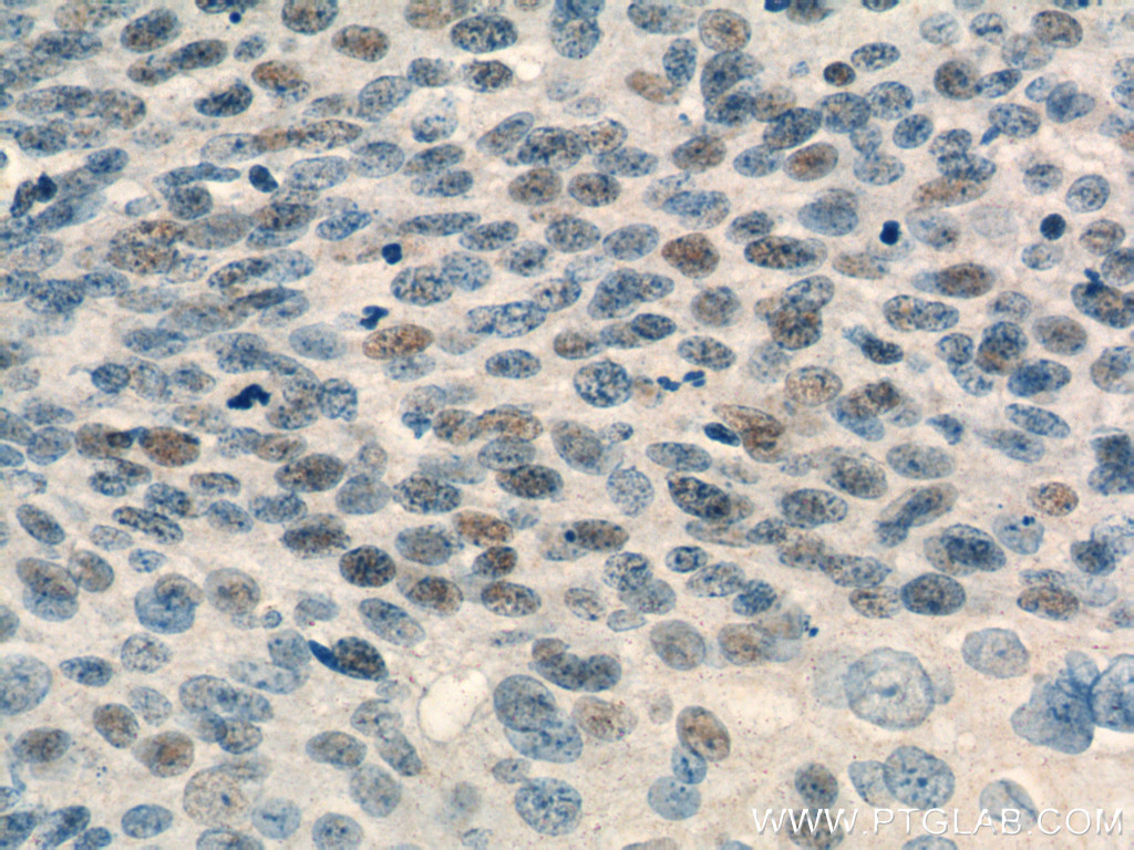 IHC staining of human cervical cancer using 66069-1-Ig