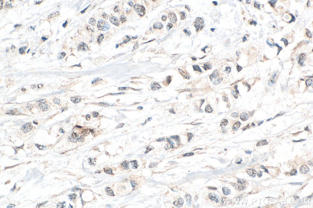 Immunohistochemical analysis of paraffin-embedded human breast cancer tissue slide using 19374-1-AP (USP10 antibody) at dilution of 1:200 (under 40x lens). Heat mediated antigen retrieval with Tris-EDTA buffer (pH 9.0). IHC staining of human breast cancer using 19374-1-AP