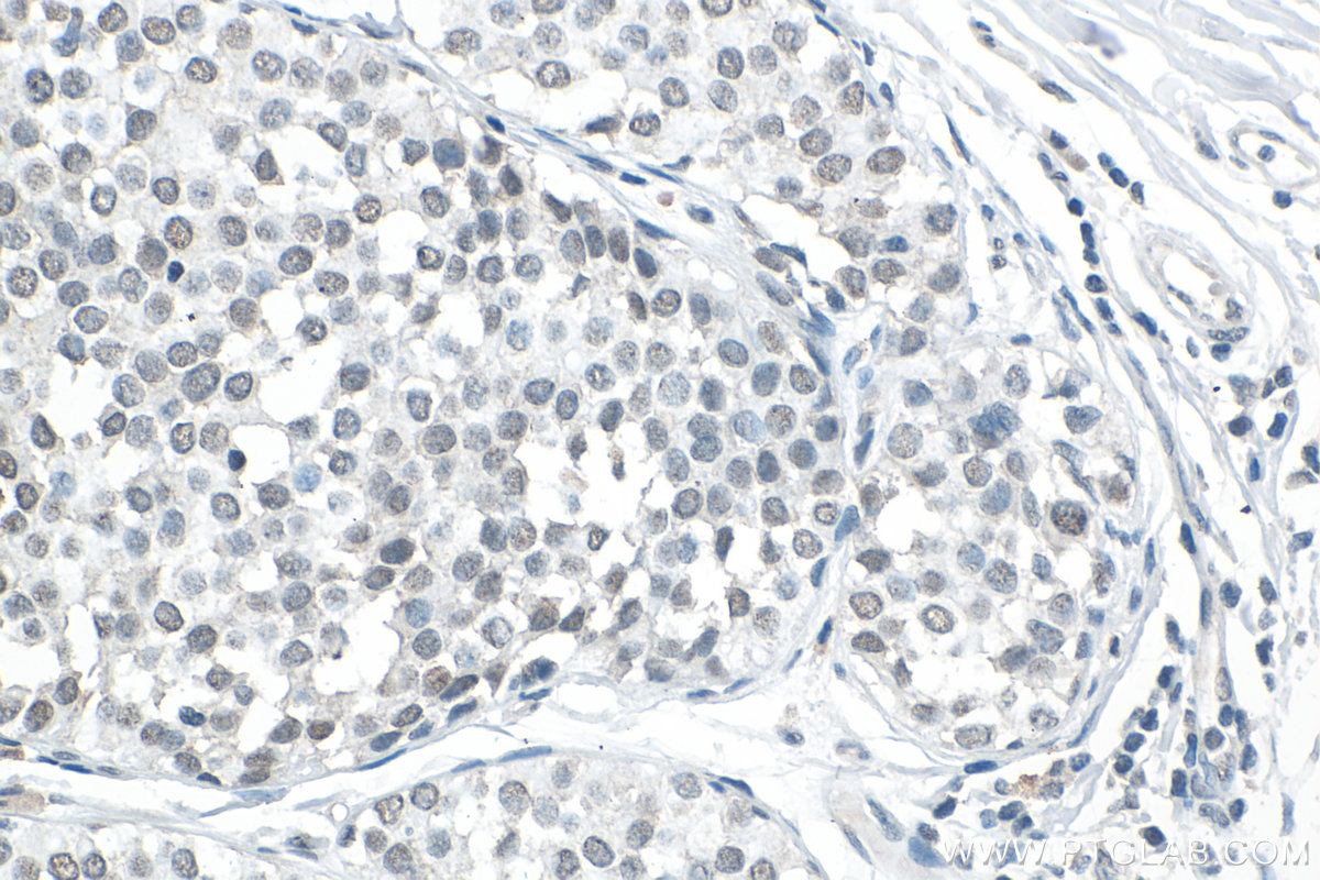IHC staining of human breast cancer using 19374-1-AP