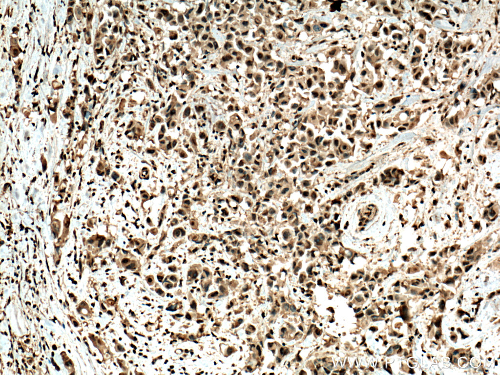 IHC staining of human breast cancer using 22340-1-AP (same clone as 22340-1-PBS)