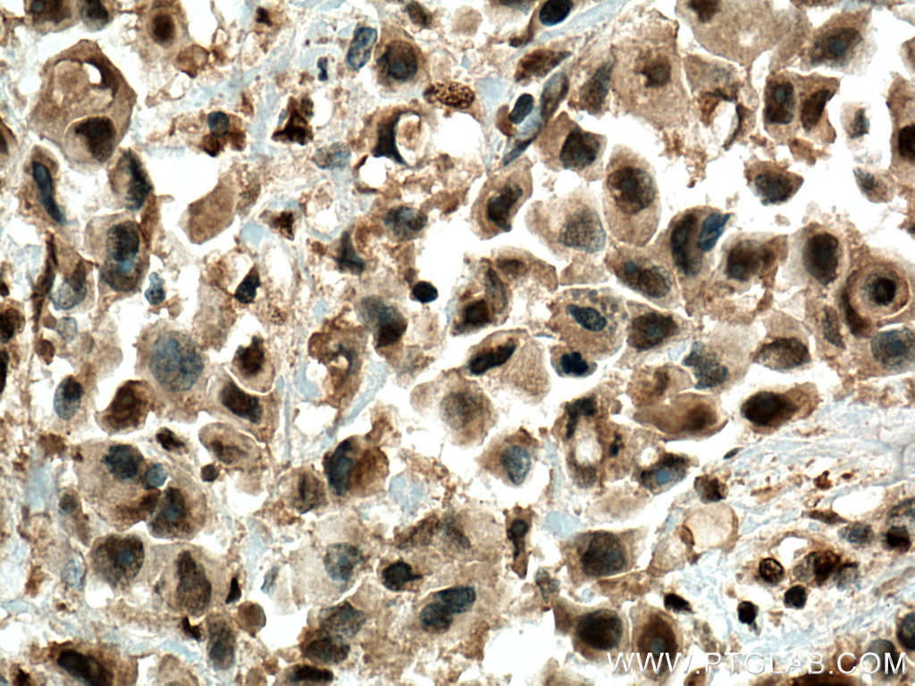 IHC staining of human breast cancer using 22340-1-AP