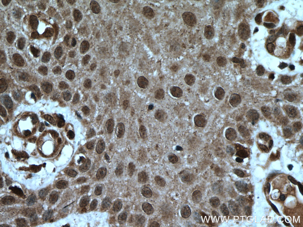 IHC staining of human skin cancer using 16840-1-AP